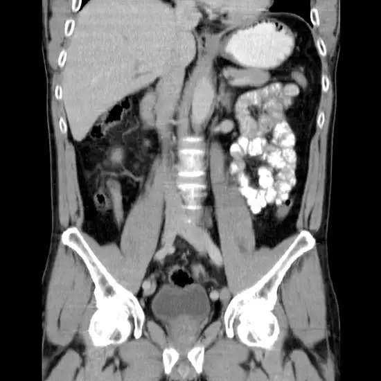 CT 3D Both Hip Joints